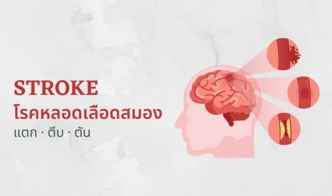 โรคหลอดเลือดสมอง แตก ตีบ ตัน