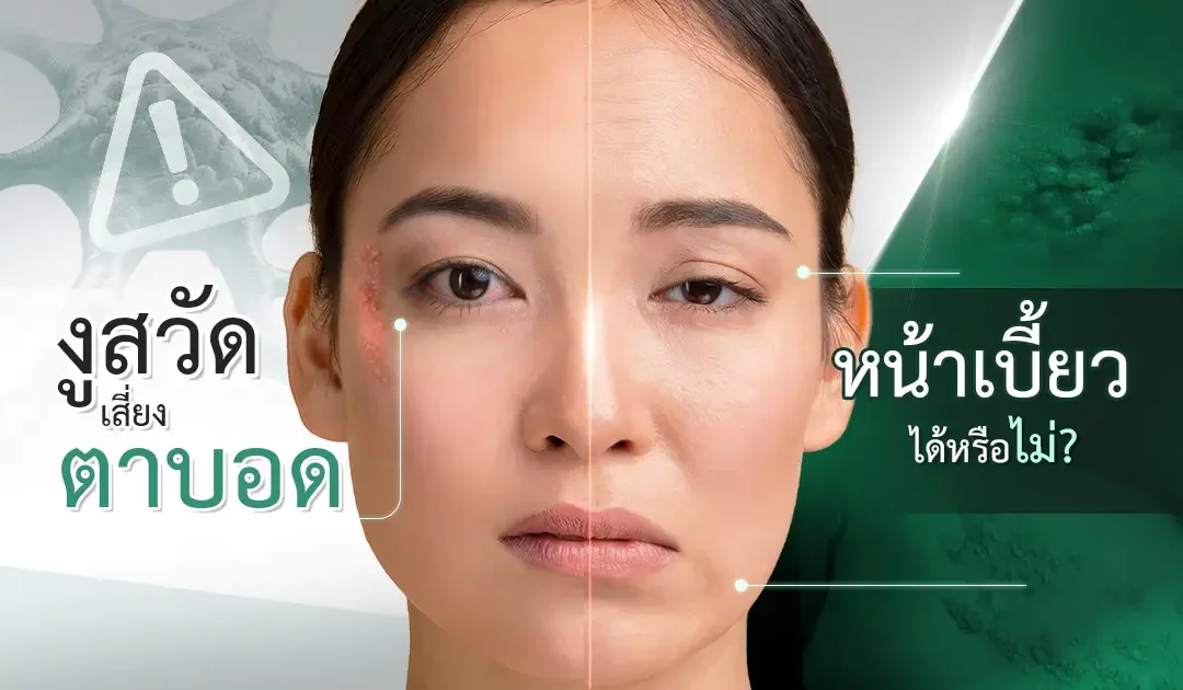 จริงหรือไม่ ‘ตาบอด-หน้าเบี้ยว’ เพราะโรคงูสวัด ?!