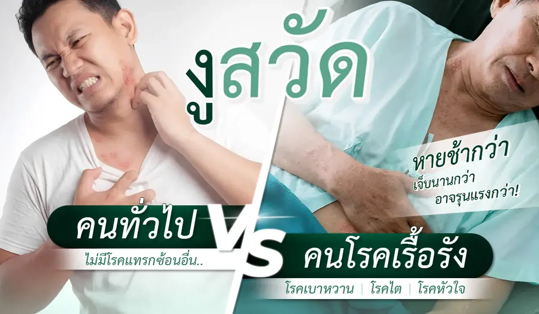 เปรียบเทียบอาการ “งูสวัด” ในคนทั่วไป vs คนป่วยโรคเรื้อรัง