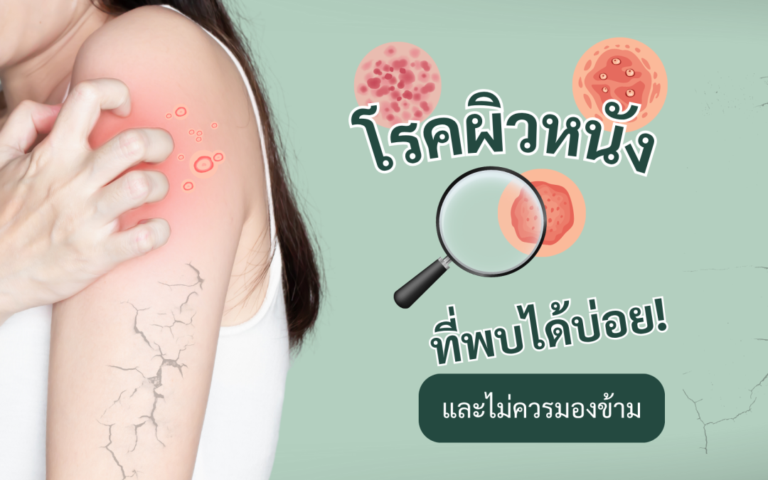 โรคผิวหนัง ที่พบได้บ่อยและไม่ควรมองข้าม